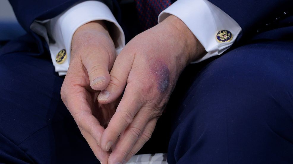A bruise appears on the back of U.S. President Donald Trump's left hand during a signing ceremony for the “Board of Peace” at the World Economic Forum (WEF) on Jan. 22, 2026 in Davos, Switzerland. (Photo by Chip Somodevilla/Getty Images)