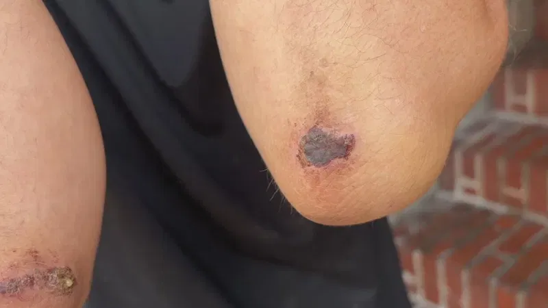 AUG 2026 - Images of alleged bruises from attack. One man, who asked not to be identified because he says he fears being targeted again, told 7News he was attacked last Thursday night, Aug. 6, 2026, after trying to help a homeless woman who he says was being assaulted. (7News)